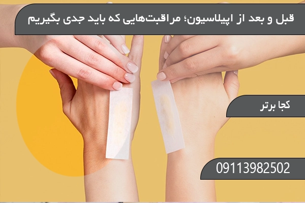  قبل و بعد از اپیلاسیون؛ مراقبت‌هایی که باید جدی بگیریم